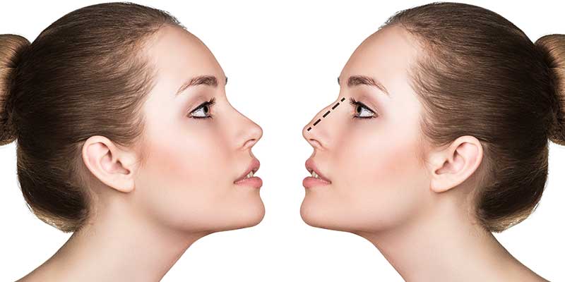 RHINOPLASTY-inner